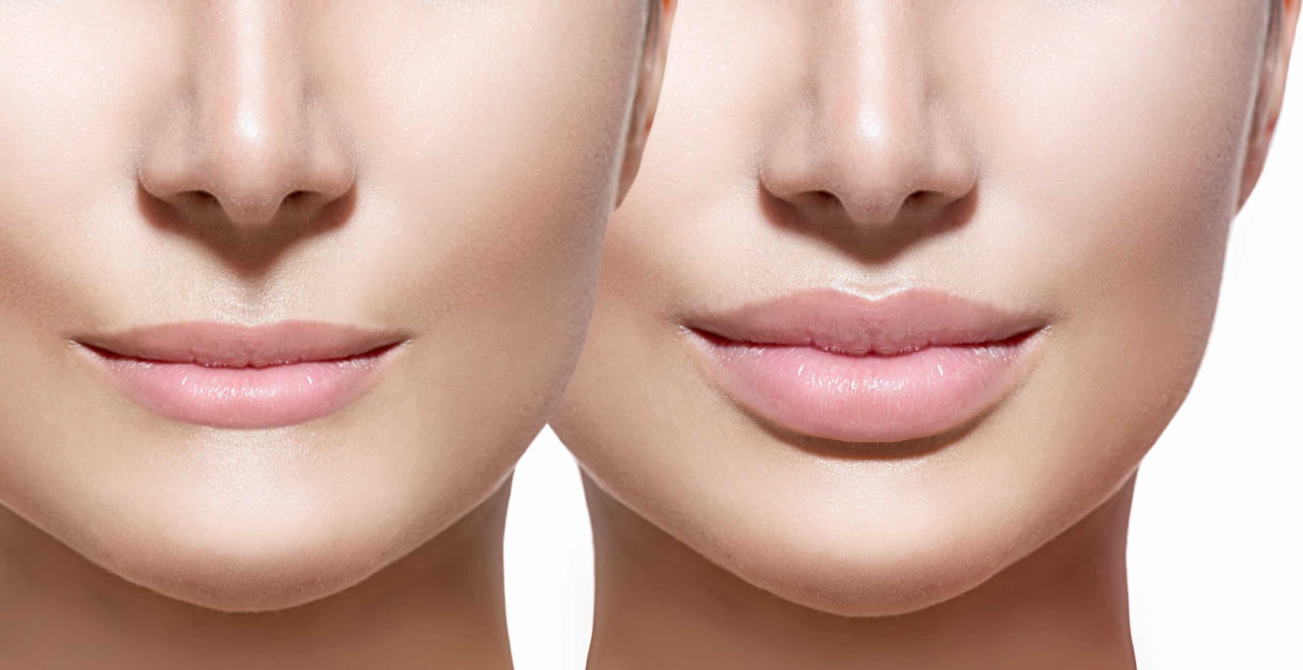 The ABCs of hyaluronic acid for lips in Bogotá